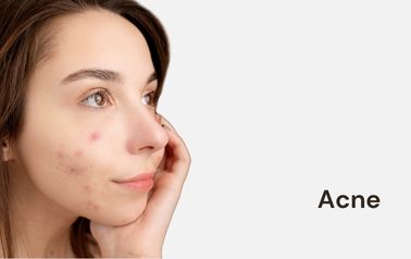 Acne removal treatment in hyderabad