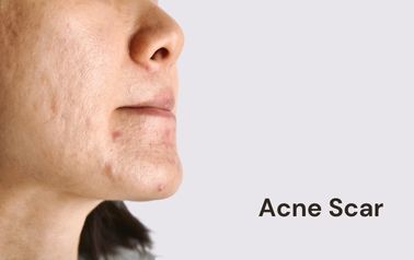 Acne scar treatment in hyderabad