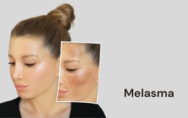 melasma treatment in hyderabad