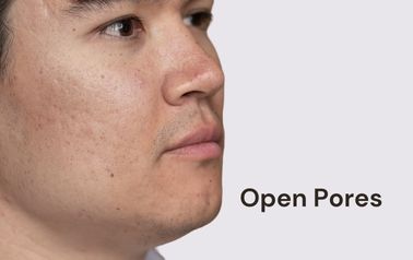 Open pores treatment in hyderabad