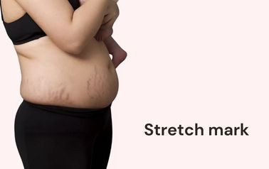 Stretch mark treatment in Hyderabad