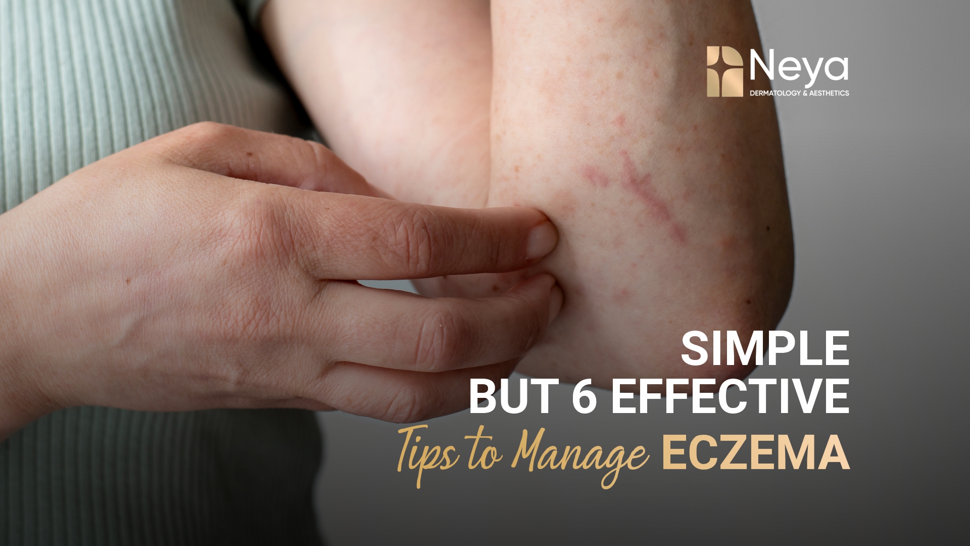 eczema treatment hyderabad