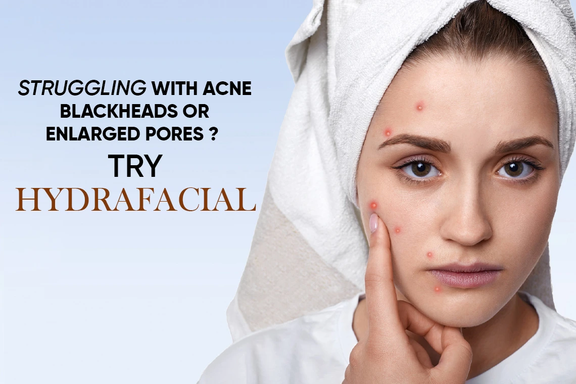 Acne Treatment with HydraFacial for Clear and Healthy Skin